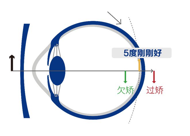 存储器与棱镜式透镜近视防控镜的关系